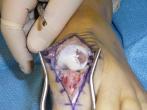 cartilage defect