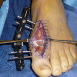 A person's foot is undergoing cartilage replacement surgery to treat bunions.