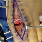 A surgeon performs a cartilage replacement surgery on a person's foot to treat bunions.