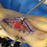 A surgeon is performing a cartilage replacement procedure for bunions on a foot.