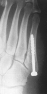 Jones fracture ORIF