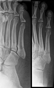 Jones fracture x ray