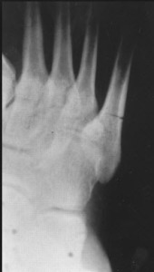 Jones fracture x ray2