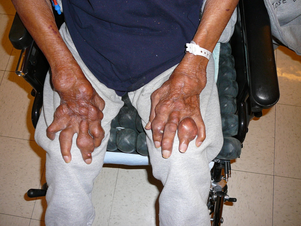 Foot pain from Gout Advanced Foot And Ankle Center Of San Diego