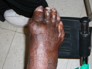 Foot pain from gout