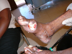 Foot gout