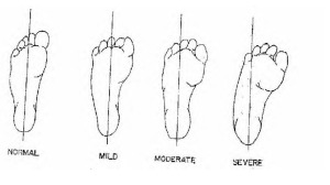 metadductus blecks test