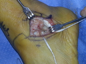 ankle ligament repair 