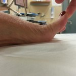 pre op hallux limitus