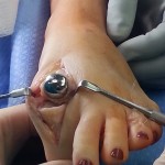 Hallux arthrosurface joint resurfacing