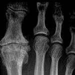 Severe Hallux Rigidus