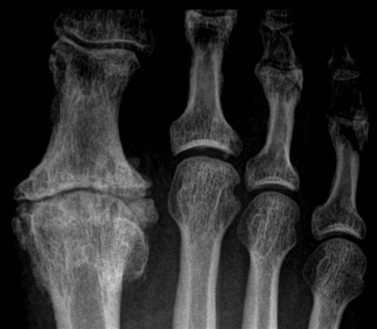 Severe Hallux Rigidus Advanced Foot And Ankle Center Of San Diego