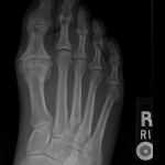 Severe Hallux Rigidus1