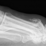 X ray Hallux rigidus