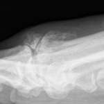 Hallux rigidus with fracture