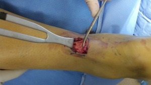 Dr Wrotslavsky repairing the achilles tendon