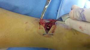 Dr Wrotslavsky repairing the achilles tendon