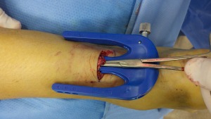 Dr Wrotslavsky repairing the achilles tendon