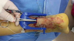 Dr Wrotslavsky repairing the achilles tendon