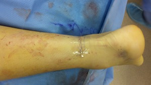 Achilles tendon repair immediate post op incision