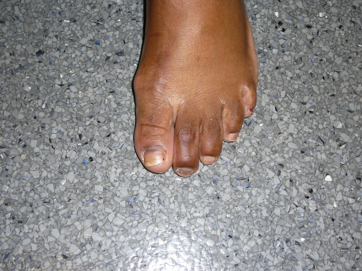 Runners toenails Foot Doctor San Diego / La Jolla Podiatrist