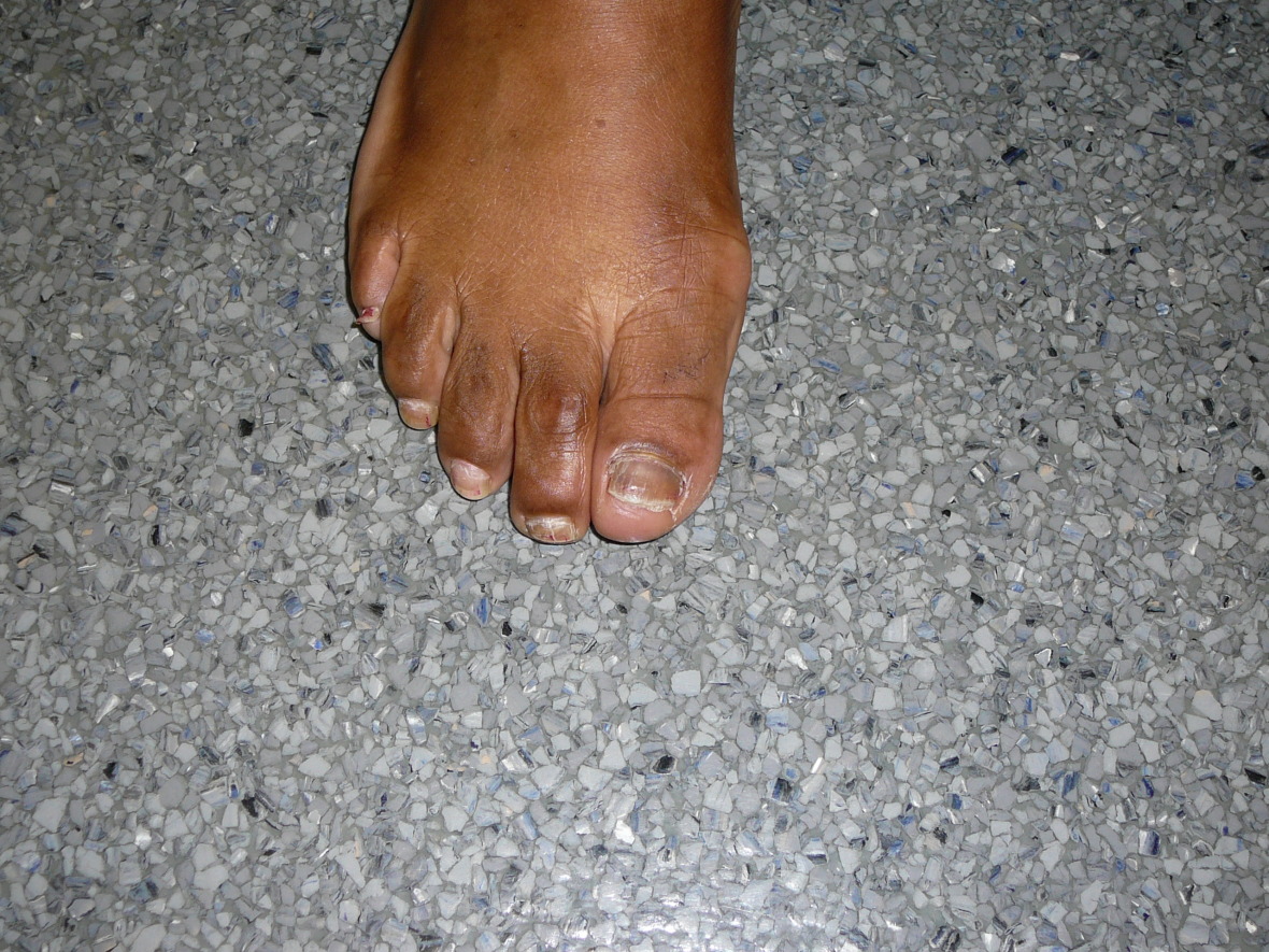 Runners toenails Foot Doctor San Diego / La Jolla Podiatrist