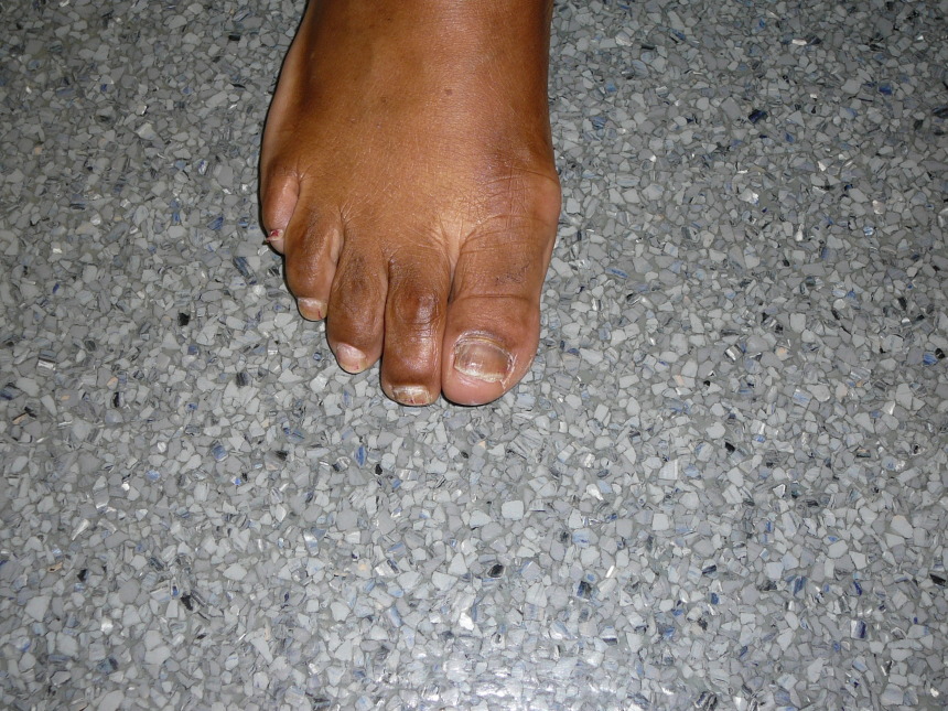 Runners toenails Foot Doctor San Diego / La Jolla Podiatrist