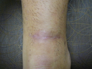 9 months post achilles repair incision Dr Wrotslavsky