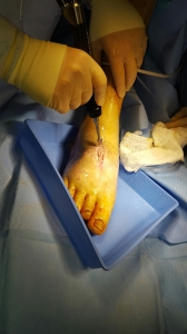 Misonix tissue debridement