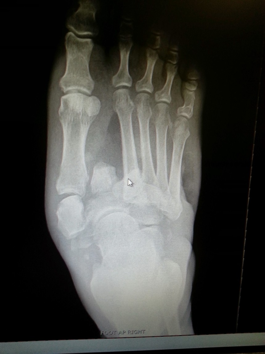 Diabetic Charcot Foot repair Foot Doctor San Diego / La Jolla Podiatrist