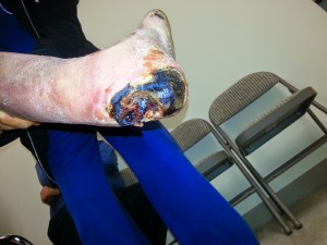 Heel wound with gangrene