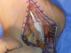 peroneal tendon wrap with ATFL repair