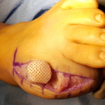 Foot with surgical mesh implant.