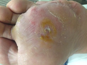 Diabetic foot ulcer 3