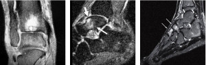 ankle bone marrow edema