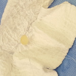 cartiform cartilage grafting