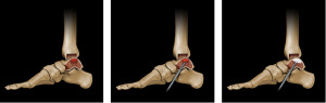 ankle subchondroplasty