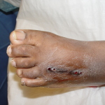 Close-up of a foot with puncture wounds.