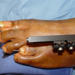 A surgical tool used on a foot.