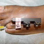 Foot with medical device and arrow.