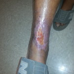 Chronic ankle wound