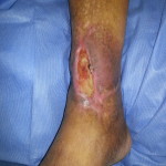 Ankle wound