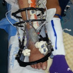 wound vac with ankle fusion