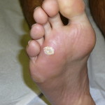 Plantars wart verruca