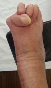 bunion hallux valgus