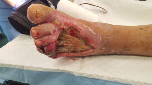 Foot ulcer with gangrene