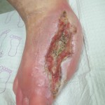 foot ulcer