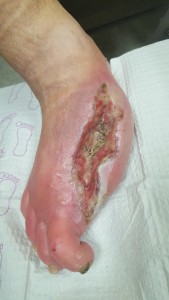 foot ulcer