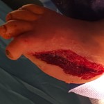 Foot wound