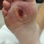 diabetic foot wound